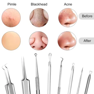 Kit 8 en 1 para Eliminar Puntos Negros y Acné + Estuche Metálico Premium™