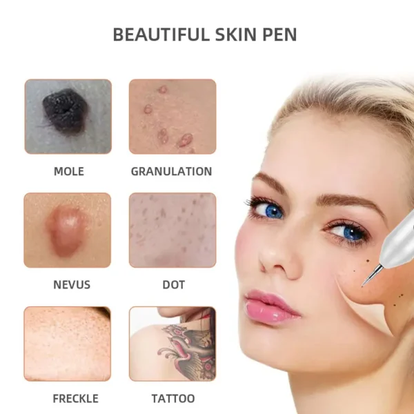 PLASMA PEN REMOVEDOR DE LUNARES, PECAS, VERRUGAS, ACROCORDONES™