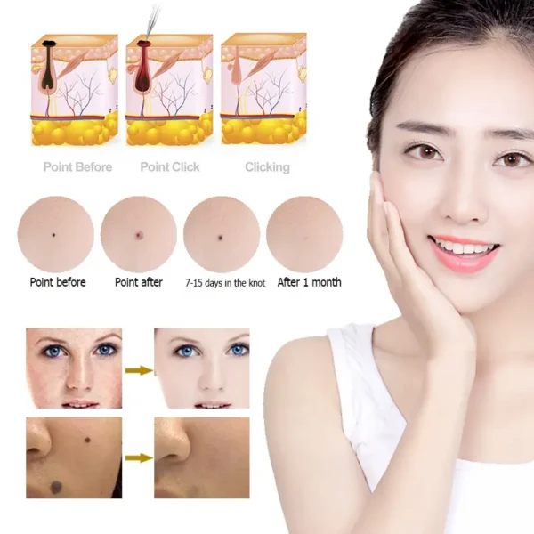 PLASMA PEN REMOVEDOR DE LUNARES, PECAS, VERRUGAS, ACROCORDONES™