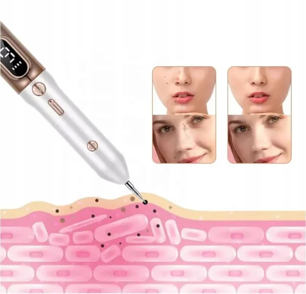 PLASMA PEN REMOVEDOR DE LUNARES, PECAS, VERRUGAS, ACROCORDONES™