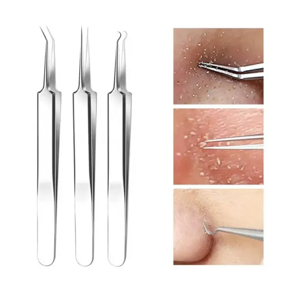 Kit Removedor de Espinillas y Puntos Negros – Agujas Faciales y Pinzas de Precisión Antiacné™